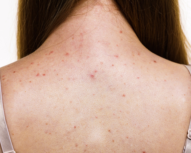 Điều Trị Mụn Lưng Tại Sen Beauty